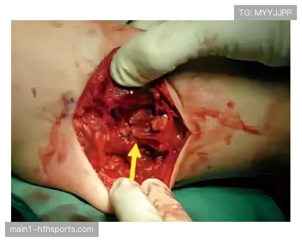 基肖恩乔治左肘尺侧副韧带撕裂 自三月起持续缺阵